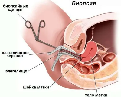 Эрозия шейки матки