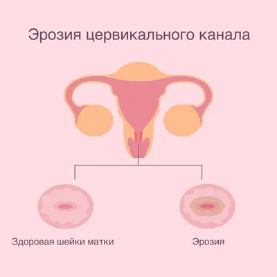 Какими способами можно вылечить эрозию шейки матки — блог медицинского  центра ОН Клиник