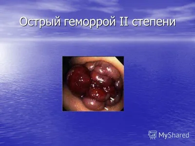 Геморрой: лечение внутреннего и внешнего геморроя у мужчин и женщин в Москве