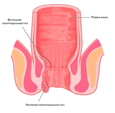 Геморрой у мужчин ♻️ Как лечить геморрой у мужчин | Мед Сити