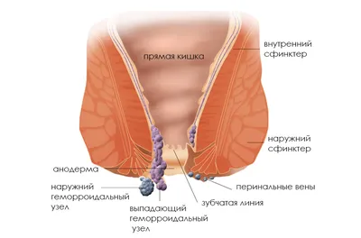 Геморрой