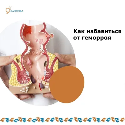 Лечение геморроя в Киеве, цена операции по удалению геморроидальных узлов |  Medcity