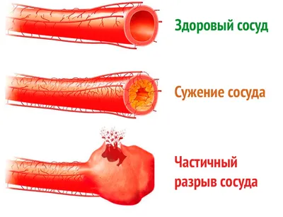 Острый геморрой: лечение, причины, симптомы, диагностика и профилактика