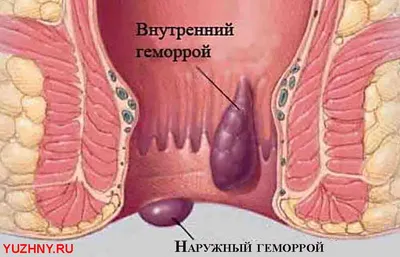 Лечение геморроя у беременных Люберцы | медицинская клиника KRH Medical