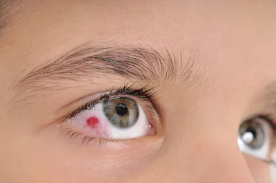 Как наши глаза реагируют на стресс - Офтальмологические клиники «Эксимер»  (Киев) – диагностика и лечение заболеваний глаз у взрослых и детей