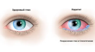 Из карих глаз в голубые | Офтальмологическая клиника «Доктора Куренкова»