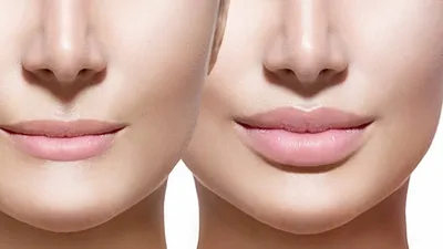 Тонкие губы | Решение проблем в клинике BeautyWay Clinic