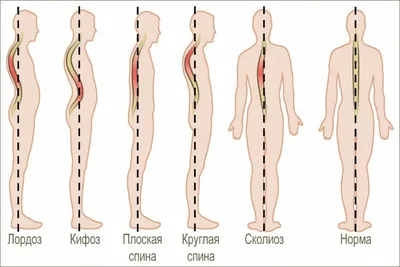 S-Образный сколиоз 1-2-3 степени, причины, лечение грудо-поясничного отдела  позвоночника