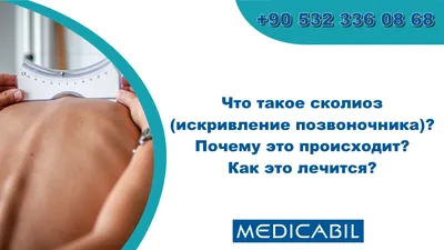 Сколиоз позвоночника: симптомы, причины, признаки, диагностика и лечение в  клинике Наран