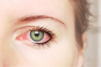 Почему глаза краснеют и как их лечить