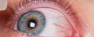 Красные глаза Индийский парень Заткнись надоеданных красных глаз мужского  подверженными влиянию конюнктивитом или после гриппа, х Стоковое  Изображение - изображение насчитывающей обработка, молодо: 198099477
