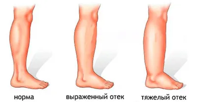 Отеки ног - причины, симптомы, лечение в медицинском центре Звезда