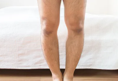 Кривые ноги: причины, типы деформаций и современные методы коррекции для  женщин и не только