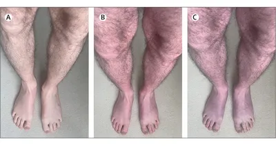 Врач объяснил, почему ноги могут менять цвет после COVID-19 – Москва 24,  14.08.2023