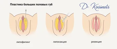 Пластика малых половых губ - лабиопластика. Фото до и после | Медицинский  форум