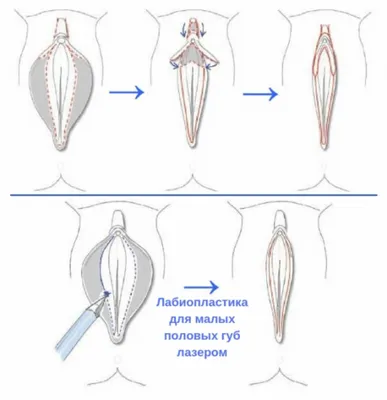 Липофилинг (увеличение) больших половых губ — Москва