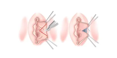 N89. 5 Синехии половых губ | Описание болезни, диагностика, лечение