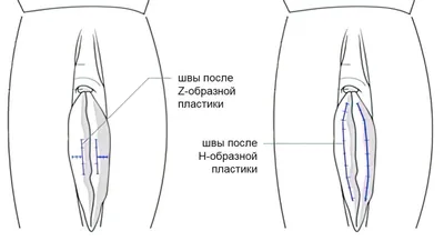 Лабиопластика половых губ – цена в Москве в медицинском центре «МАК ЭКО»