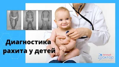 Рахит у детей младшего и подросткового возраста | Рефераты Педиатрия |  Docsity