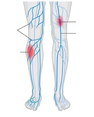 Лечение тромбофлебита в Балашихе - Областной флебололический центр  «МедФлеб» на СКИДКОМ.РФ