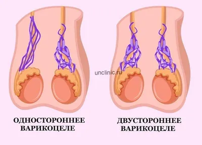 Операция мармара при варикоцеле – цена в Москве, порядок проведения  процедуры в медицинском центре детской андрологии