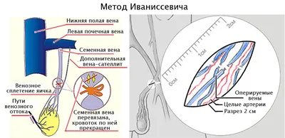 Вы знаете, что такое варикоцеле? Чем может навредить одна «поломанная» вена  мужскому здоровью | О здоровье: с медицинского на русский | Дзен