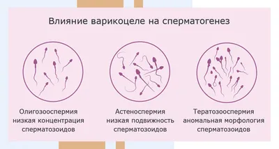 Лапароскопия варикоцеле у мальчиков, лечение, удаление у детей, цена  хирургической операции. | Москва