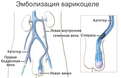 Варикоцеле у мужчин - причины, симптомы, диагностика и лечения в ИСЦ