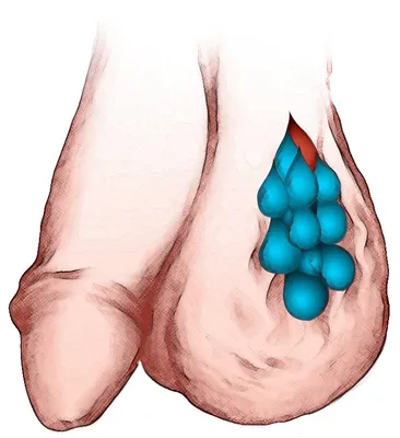Как лечить варикоцеле яичка