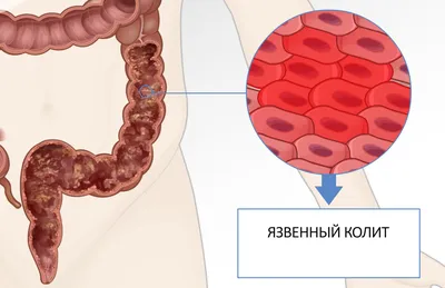 Лечение кишечника. Лечение лечение кишечника от ведущих докторов | Лучшие  клиники | Отзывы | Patient-mt.ru