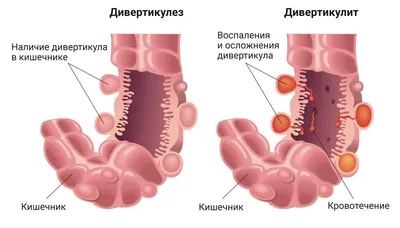 Онкология его боится»: Этот продукт в вареном виде не пропустит рак в  кишечник — можно есть хоть каждый день - новости Хибины.ru / Новости за  декабрь 2023