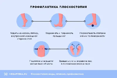 Плоскостопие - виды, симптомы и лечение в Центре остеопатии