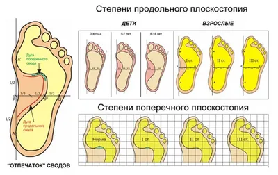 Как определить плоскостопие в домашних условиях? | медицинские товары и  медтехника в магазине Ортосалон