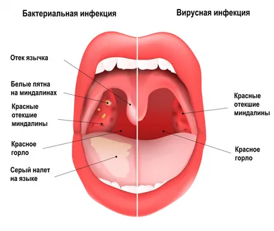Воспаление горла: как снять, чем полоскать и чем лечить?