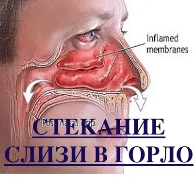 Часто болит горло? Хронический тонзиллит. Чем опасен? | Нутрициолог из Сочи  | Дзен