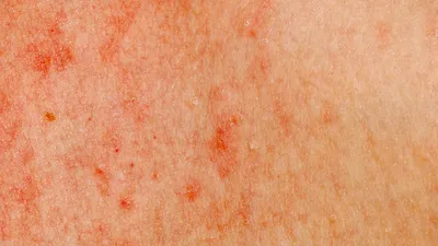 Красные пятна на коже – причины возникновения заболевания, какой врач  лечит, диагностика, профилактика и лечение