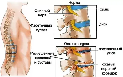 RU2232003C1 - Способ индивидуально-физической реабилитации и контроля ее  эффективности при остеохондрозе шейного отдела позвоночника - Google Patents