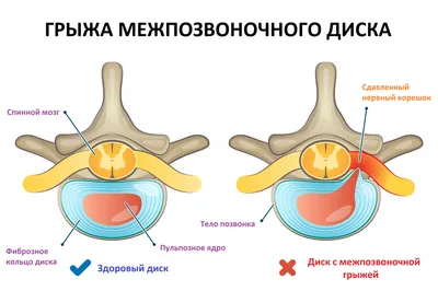 ЛФК при шейном остеохондрозе: гимнастика и упражнения для мышц шеи