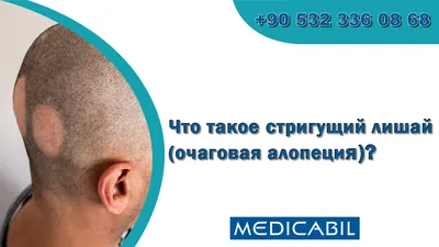 Cтригущий лишай: симптомы, диагностика, лечение - MedicalAdvice.ru