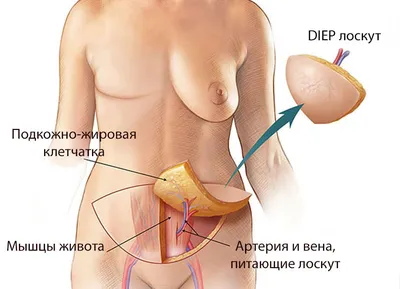 Что такое Лоскут передней брюшной стенки (DIEP flap) | NEOPLASTY