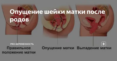 Этапы родов: предвестники, схватки, открытие шейки матки.