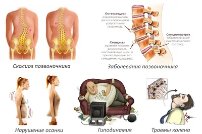 Остеохондроз грудного отдела позвоночника - симптомы и лечение