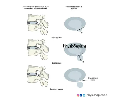 Грыжа межпозвоночного диска – выпячивание пульпозного ядра диска.