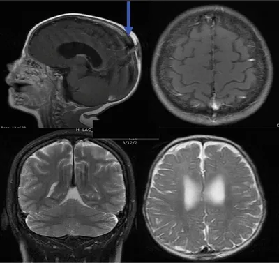 МРТ головного мозга: что показывает, когда назначается