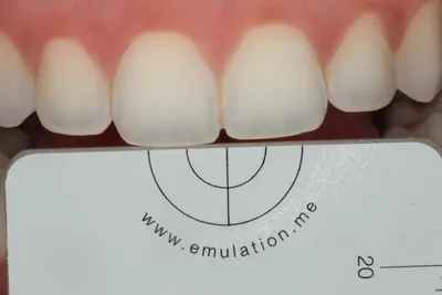 Что такое бюгельный протез на зубы? | Стоматология Smile-at-Once | Дзен