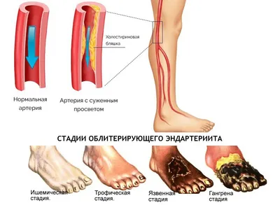Облитерирующий эндартериит — Заболевания - причины, симптомы, диагностика в  СПб