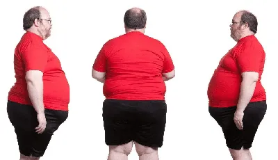 Что такое ожирение?