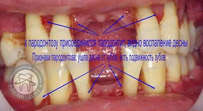 Лечение десен в стоматологии пародонтоз пародонтит и гингивит