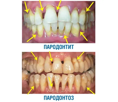 Пародонтоз 9 Фото Лечение В Домашних Условиях ЛюмиДент