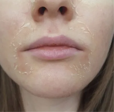 Пилинг Джесснера: омоложение кожи лица без пластики, боли и реабилитации |  Косметология и эстетическая медицина | Дзен